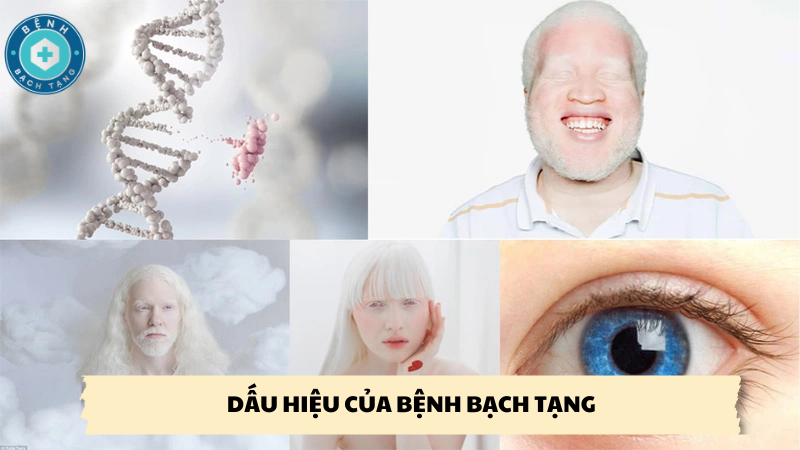 dấu hiệu của bệnh bạch tạng