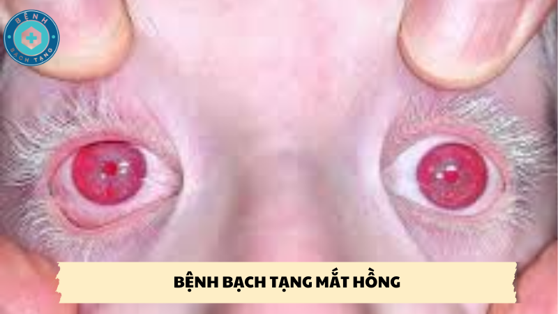 bệnh bạch tạng mắt hồng