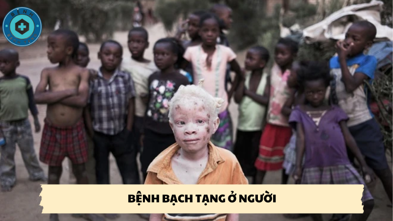 bệnh bạch tạng ở người